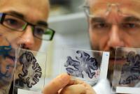 Ученые сделали новое открытие в болезни Альцгеймера