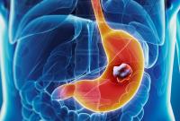 Препараты от изжоги удваивают риск возникновения рака желудка