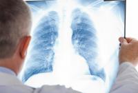 Минздрав: от туберкулеза в Украине умерло три раза больше, чем во время боевых действий в АТО