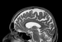 Искусственный интеллект научился распознавать болезнь Альцгеймера раньше медиков