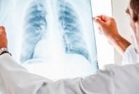 На лекарства против туберкулеза в прошлом году из бюджета выделили почти 500 млн грн