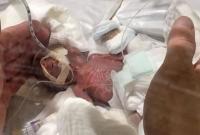 Самый крошечный мальчик. Из токийской больницы выписали младенца, весившего при рождении 268 грамм