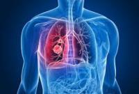 Кировоградская область занимает второе место в стране по уровню заболеваемости туберкулезом
