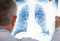 В Украине за 8 лет удвоилось число случаев устойчивого к лекарствам туберкулеза
