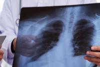 В Киевской области с начала года от пневмонии умерло 65 человек