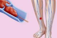 Внимание! Первые симптомы тромба в ноге