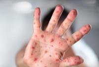 В Пакистане бушует эпидемия лихорадки, пострадали 20 тыс. человек