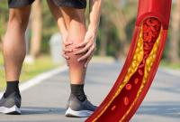 Повышенный холестерин: серьезные предупреждающие признаки в ногах