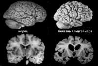 Медики научились диагностировать болезнь Альцгеймера до появления симптомов