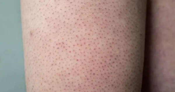 Почему руки зимой покрываются красными бугорками: врач назвала истинную причину