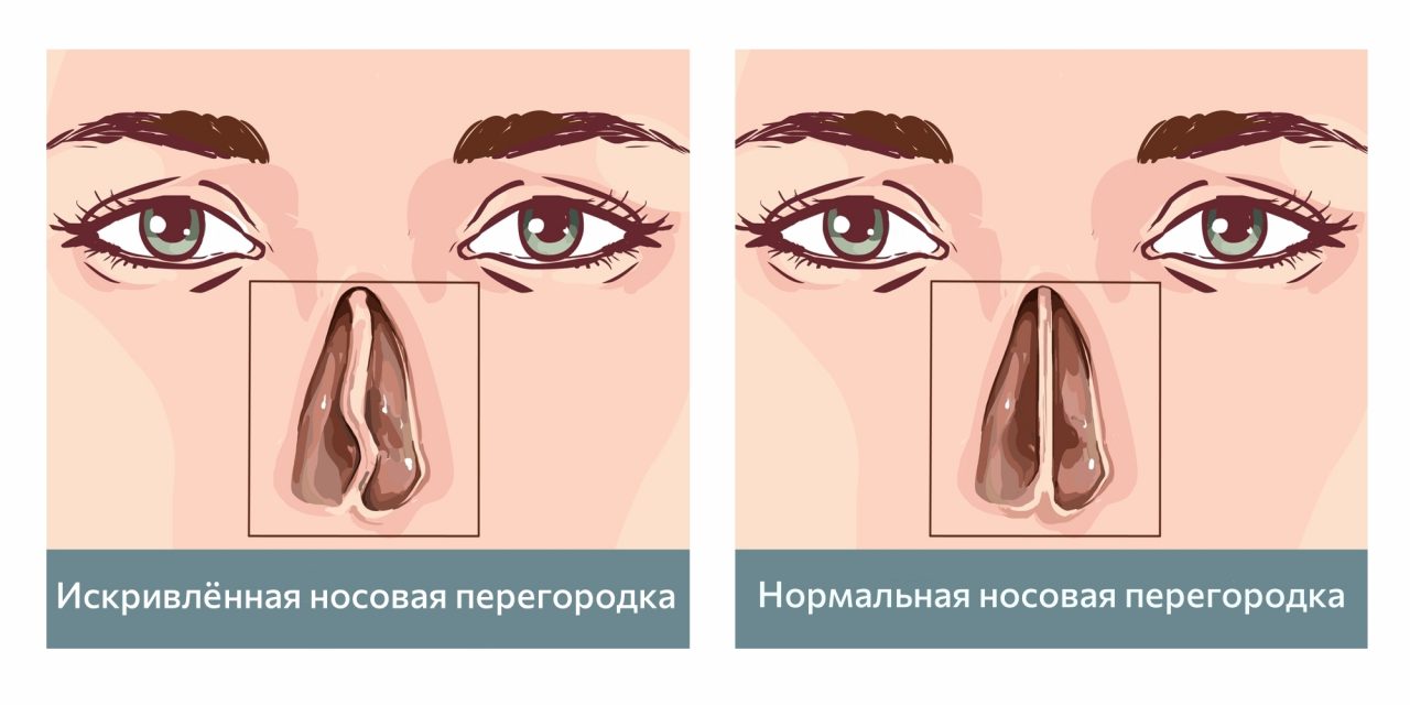 Что такое искривление носовой перегородки и как его лечить