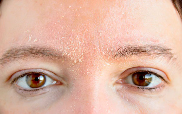 Шелушение кожи лица: причины и как с этим бороться